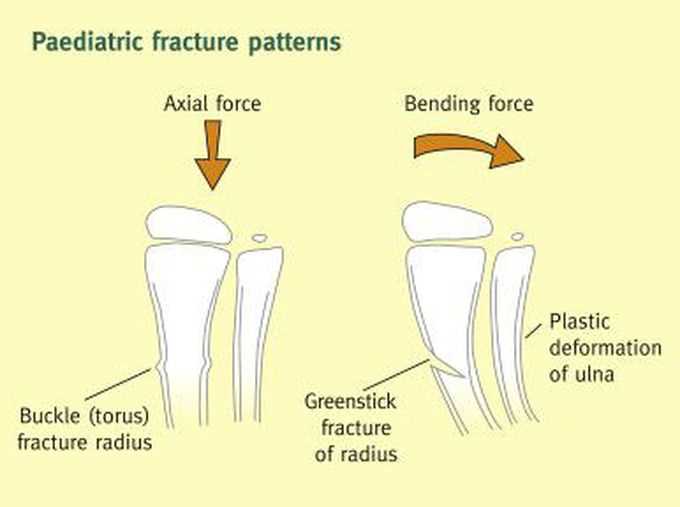 Activity 15-1 glass fracture pattern analysis answers