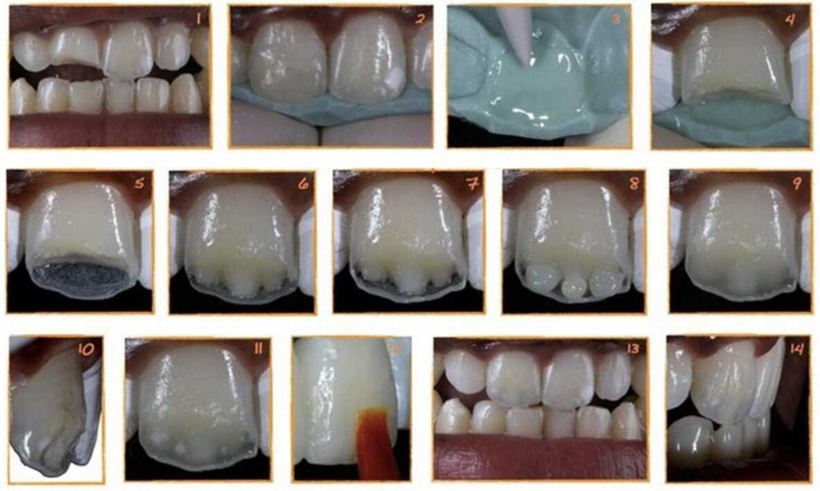 The Process of Caries Susceptibility Testing